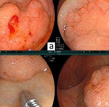 Grandes e pequenas lesões colorretais são efetivamente tratadas pela técnica de mucosectomia
