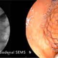 Endosonography-guided rescue procedures after failed ERCP in a patient with pancreatic ductal adenocarcinoma