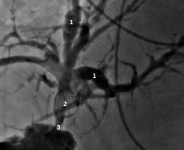 Percutaneous cholangioscopy and laser biliary lithotripsy for biliary intrahepatic stones management: case report