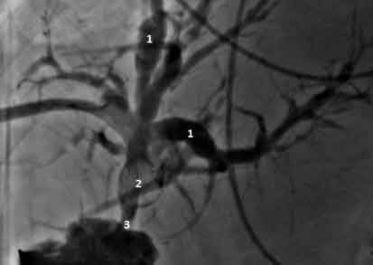 Percutaneous cholangioscopy and laser biliary lithotripsy for biliary intrahepatic stones management: case report