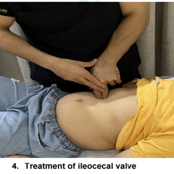 Effect of visceral manipulation on children with refractory chronic functional constipation:  a randomized controlled trial