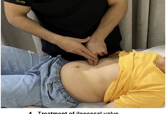 Effect of visceral manipulation on children with refractory chronic functional constipation:  a randomized controlled trial