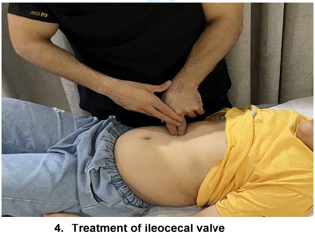 Effect of visceral manipulation on children with refractory chronic functional constipation:  a randomized controlled trial