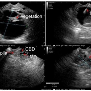 III brazilian consensus statement on endoscopic ultrasound