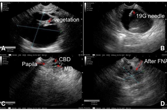 III brazilian consensus statement on endoscopic ultrasound