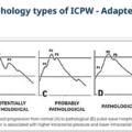 Non-invasive method of monitoring intracranial pressure for the evaluation of hepatic encephalopathy