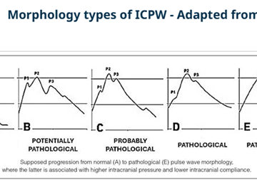 Non-invasive method of monitoring intracranial pressure for the evaluation of hepatic encephalopathy