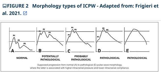 Non-invasive method of monitoring intracranial pressure for the evaluation of hepatic encephalopathy