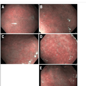 Utility of endoscopic narrow-band imaging for identifying h. Pylori-associated gastritis in children