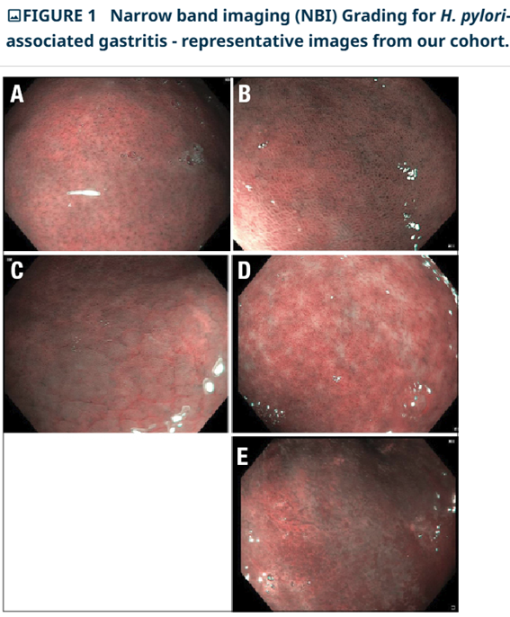 Utility of endoscopic narrow-band imaging for identifying h. Pylori-associated gastritis in children