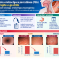 Impact of Percutaneous Endoscopic Gastrostomy on the Esophageal/ Gastric Mucosa and Helicobacter pylori in Individuals with Neurogenic Oropharyngeal Dysphagia